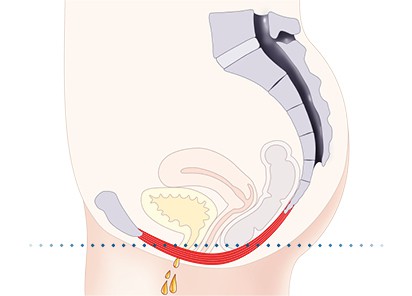 Pelvic-Floor Muscle Repair 5 Pelvic floor muscles Rayleigh
