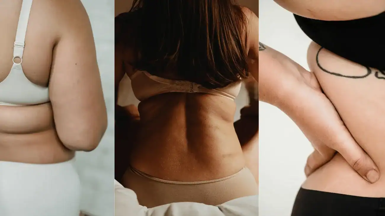 Diastasis Recti Treatment in the UK: Non-Surgical Options That Actually Work 4 Frequently Asked Questions diastasis recti